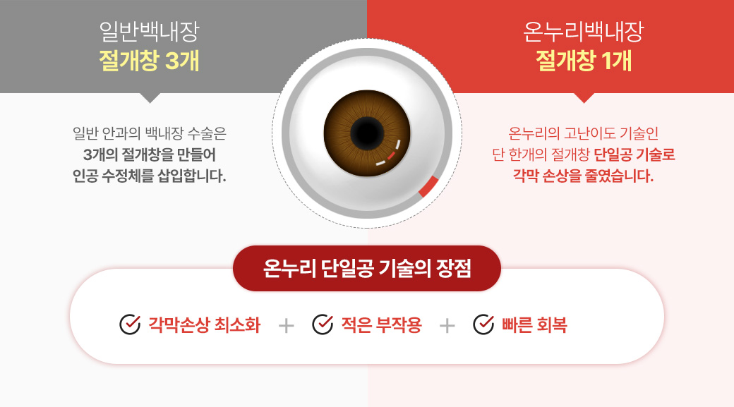 일반백내장 절개창 3개 : 일반 안과의 백내장 수술은 3개의 절개창을 만들어 인공 수정체를 삽입합니다. | 온누리백내장 절개창 1개 : 온누리의 고난이도 기술인 단 한개의 절개창 단일공 기술로 각막 손상을 줄였습니다. 온누리 단일공 기술의 장점 : 각막손상 치쇠화 + 적은 부작용 + 빠른 회복