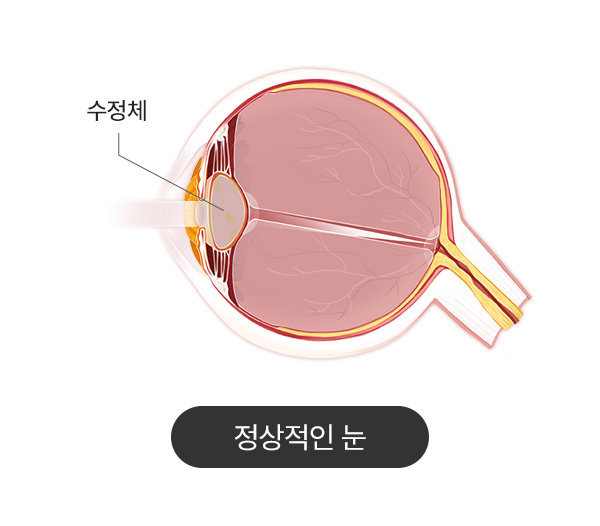 정상적인 눈