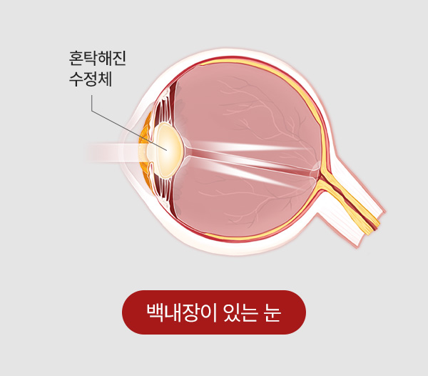 백내장이 있는 눈