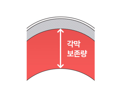 각막 보존량