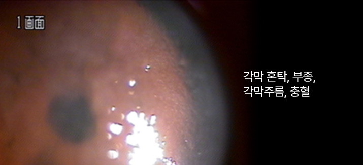 각막 혼탁, 부종, 각막주름, 충혈