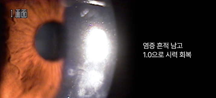 염증 흔적 남고 1.0으로 시력 회복