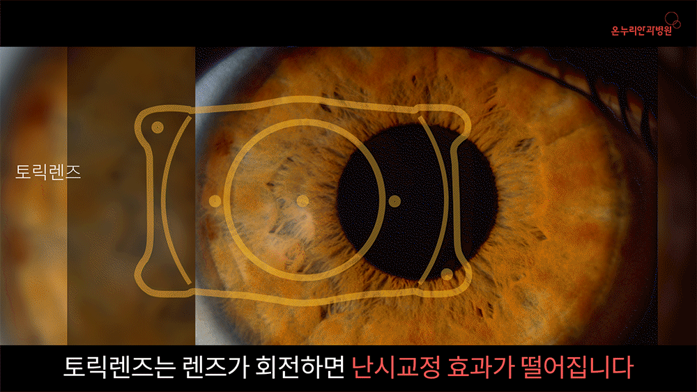 토릭렌즈는 렌즈가 회전하면 난시교정 효과가 떨어집니다.