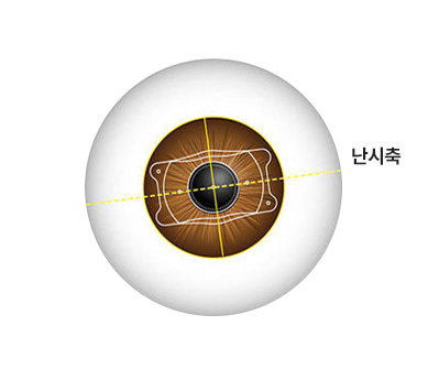 난시축