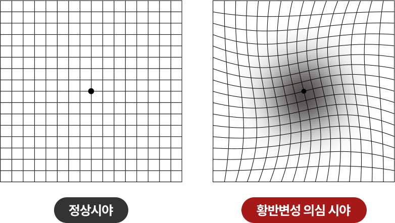 정상시야 / 황반변성 의심 시야