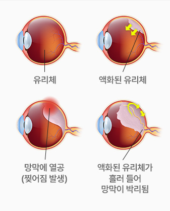 유리체 / 액화된 유리체 / 망막에 열공(찢어짐 발생) / 액화된 유리체가 흘러 들어 망막이 박리됨