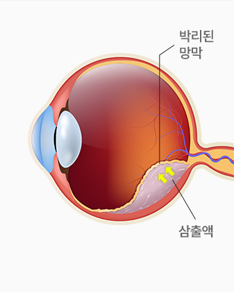 박리된 망막 / 삼출액