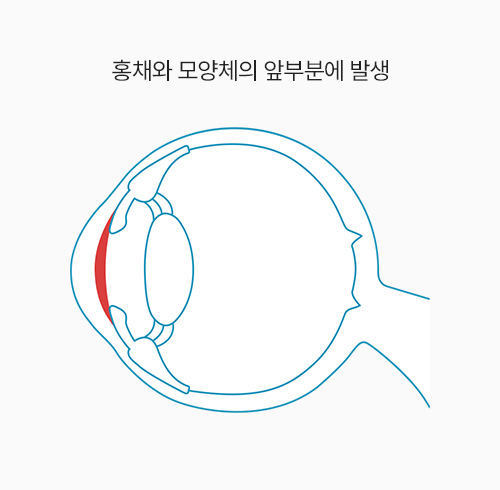 홍채와 모양체의 앞부분에 발생