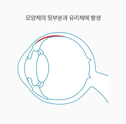 모양체의 뒷부분과 유리체에 발생