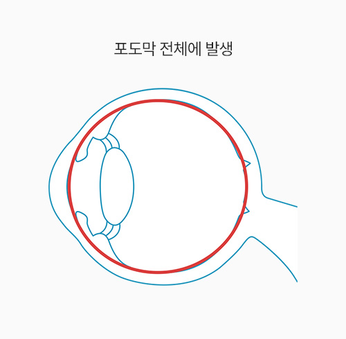 포도막 전체에 발생